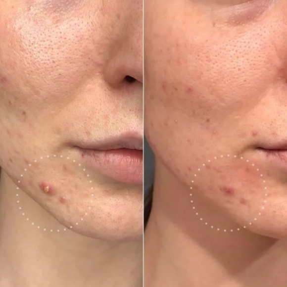 hero. MIGHTY PATCH Invisible + 72 HYDROCOLLOID PATCHES - Picture 6 of 6